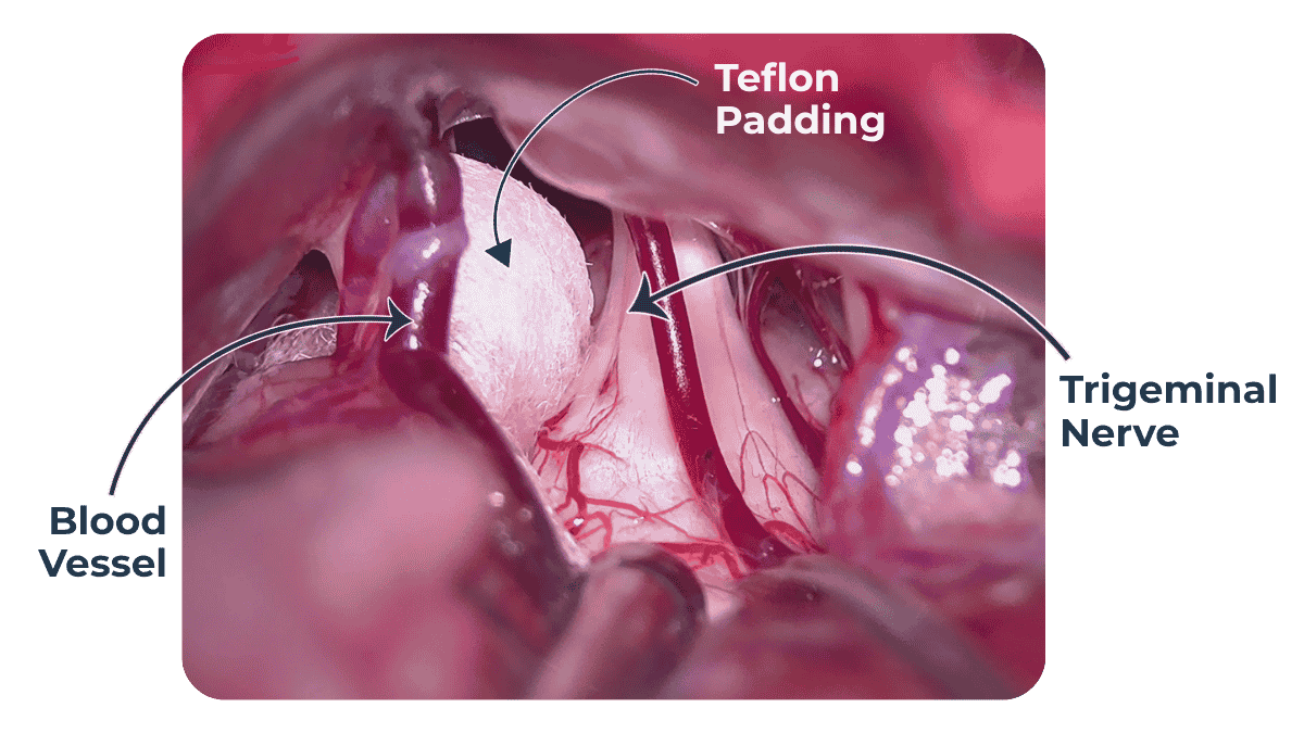 trigeminal neuralgia treatment in pune maharashtra india