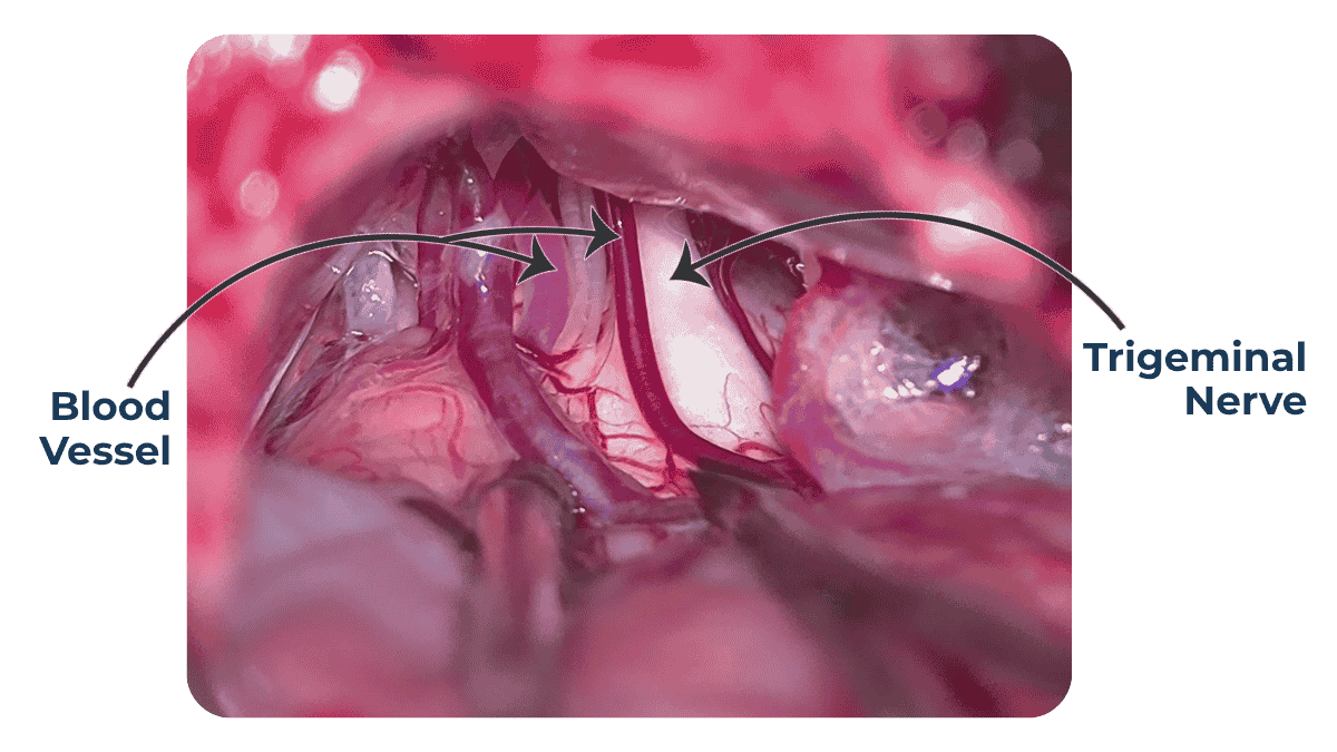 trigeminal neuralgia treatment in pune maharashtra india. india's best mvd surgeon dr jaydev panchwagh