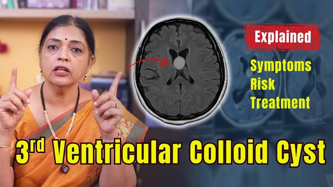 Third Ventricular Colloid Cyst: A Brain Tumor That Can Be Silent but Dangerous